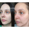 اسنس ضد چروک کمپلکس 9 پپتاید مدی پیل حجم دهنده و آبرسان قوی پوست Medi-Peel All in One Peptide 9 Volume Essence